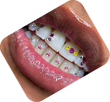 Strass dentaire