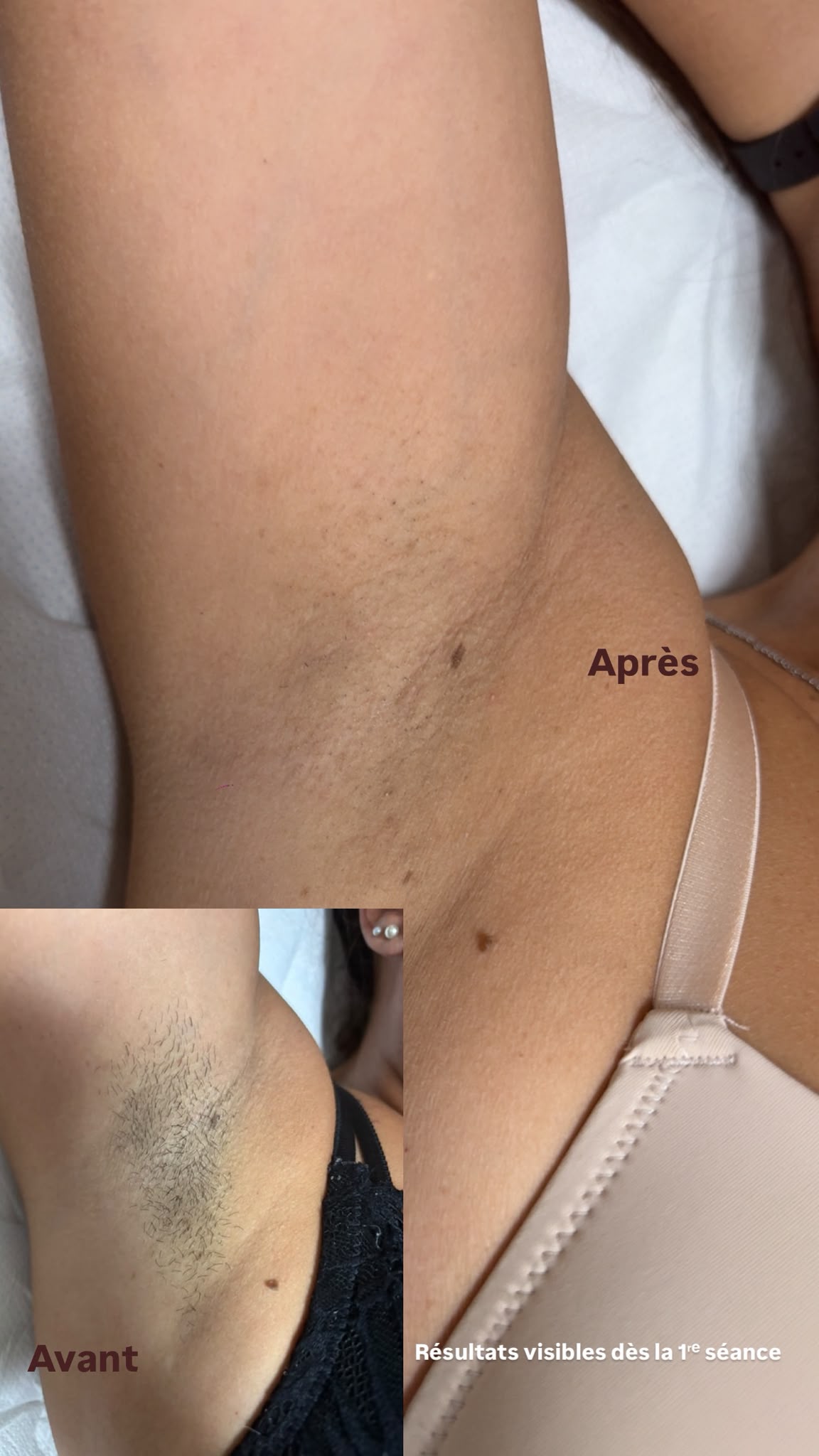 Épilation laser