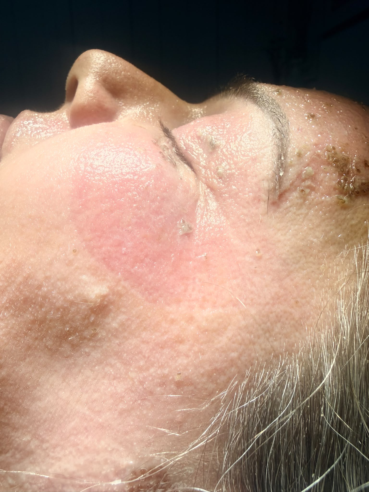 Résultat d'un soin plasma du visage à Vétroz